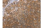 The image on the left is immunohistochemistry of paraffin-embedded Human cervical cancer tissue using CSB-PA929761(CCL21 Antibody) at dilution 1/40, on the right is treated with fusion protein. (Original magnification: 