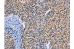 The image on the left is immunohistochemistry of paraffin-embedded Human liver cancer tissue using CSB-PA929814(DUSP10 Antibody) at dilution 1/25, on the right is treated with fusion protein. (Original magnification: 