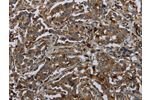 The image on the left is immunohistochemistry of paraffin-embedded Human liver cancer tissue using CSB-PA929928(GLUL Antibody) at dilution 1/60, on the right is treated with fusion protein. (Original magnification: 