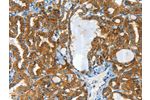 The image on the left is immunohistochemistry of paraffin-embedded Human thyroid cancer tissue using CSB-PA930031(CLPTM1L Antibody) at dilution 1/60, on the right is treated with synthetic peptide. (Original magnification: 