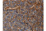 The image on the left is immunohistochemistry of paraffin-embedded Human liver cancer tissue using CSB-PA930156(CD46 Antibody) at dilution 1/30, on the right is treated with fusion protein. (Original magnification: 