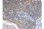 The image on the left is immunohistochemistry of paraffin-embedded Human cervical cancer tissue using CSB-PA930405(ELP3 Antibody) at dilution 1/15, on the right is treated with synthetic peptide. (Original magnification: 