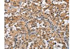 The image on the left is immunohistochemistry of paraffin-embedded Human thyroid cancer tissue using CSB-PA930678(FLT3 Antibody) at dilution 1/50, on the right is treated with fusion protein. (Original magnification: 