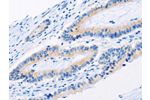 The image on the left is immunohistochemistry of paraffin-embedded Human colon cancer tissue using CSB-PA930762(BMP3 Antibody) at dilution 1/30, on the right is treated with fusion protein. (Original magnification: 