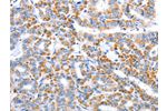 The image on the left is immunohistochemistry of paraffin-embedded Human thyroid cancer tissue using CSB-PA930766(CLEC1B Antibody) at dilution 1/15, on the right is treated with fusion protein. (Original magnification: 