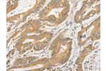 The image on the left is immunohistochemistry of paraffin-embedded Human colon cancer tissue using CSB-PA931023(ATG5 Antibody) at dilution 1/40, on the right is treated with fusion protein. (Original magnification: 