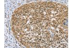 The image on the left is immunohistochemistry of paraffin-embedded Human cervical cancer tissue using CSB-PA931107(EDIL3 Antibody) at dilution 1/20, on the right is treated with fusion protein. (Original magnification: 