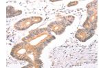The image on the left is immunohistochemistry of paraffin-embedded Human colon cancer tissue using CSB-PA931399(ABCF2 Antibody) at dilution 1/25, on the right is treated with fusion protein. (Original magnification: 