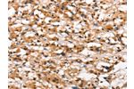 The image on the left is immunohistochemistry of paraffin-embedded Human thyroid cancer tissue using CSB-PA932813(DGAT1 Antibody) at dilution 1/40, on the right is treated with synthetic peptide. (Original magnification: 