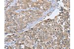 The image on the left is immunohistochemistry of paraffin-embedded Human breast cancer tissue using CSB-PA933387(CYTH1 Antibody) at dilution 1/40, on the right is treated with synthetic peptide. (Original magnification: 