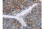 The image on the left is immunohistochemistry of paraffin-embedded Human liver cancer tissue using CSB-PA933658(APOBEC4 Antibody) at dilution 1/20, on the right is treated with fusion protein. (Original magnification: 