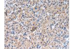 The image on the left is immunohistochemistry of paraffin-embedded Human liver cancer tissue using CSB-PA933792(GLRA1 Antibody) at dilution 1/20, on the right is treated with synthetic peptide. (Original magnification: 