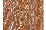 The image on the left is immunohistochemistry of paraffin-embedded Human gastic cancer tissue using CSB-PA934012(GCG Antibody) at dilution 1/20, on the right is treated with synthetic peptide. (Original magnification: 