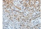 The image on the left is immunohistochemistry of paraffin-embedded Human lung cancer tissue using CSB-PA934176(CDKN1A Antibody) at dilution 1/15, on the right is treated with fusion protein. (Original magnification: 