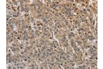 The image on the left is immunohistochemistry of paraffin-embedded Human liver cancer tissue using CSB-PA934409(ADO Antibody) at dilution 1/30, on the right is treated with synthetic peptide. (Original magnification: 