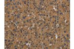 The image on the left is immunohistochemistry of paraffin-embedded Human liver cancer tissue using CSB-PA934669(GBP5 Antibody) at dilution 1/50, on the right is treated with fusion protein. (Original magnification: 