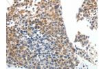 The image on the left is immunohistochemistry of paraffin-embedded Human liver cancer tissue using CSB-PA935474(ABCG5 Antibody) at dilution 1/20, on the right is treated with synthetic peptide. (Original magnification: 