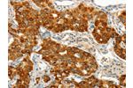 The image on the left is immunohistochemistry of paraffin-embedded Human lung cancer tissue using CSB-PA935501(CIB1 Antibody) at dilution 1/50, on the right is treated with synthetic peptide. (Original magnification: 