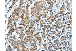 The image on the left is immunohistochemistry of paraffin-embedded Human breast cancer tissue using CSB-PA935612(ALDH4A1 Antibody) at dilution 1/45, on the right is treated with fusion protein. (Original magnification: 