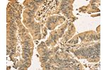The image on the left is immunohistochemistry of paraffin-embedded Human colon cancer tissue using CSB-PA936102(CDCA8 Antibody) at dilution 1/40, on the right is treated with fusion protein. (Original magnification: 