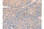 The image on the left is immunohistochemistry of paraffin-embedded Human liver cancer tissue using CSB-PA936160(CD109 Antibody) at dilution 1/30, on the right is treated with synthetic peptide. (Original magnification: 