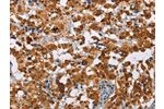 The image on the left is immunohistochemistry of paraffin-embedded Human thyroid cancer tissue using CSB-PA936340(ATXN1 Antibody) at dilution 1/40, on the right is treated with fusion protein. (Original magnification: 