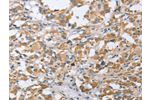 The image on the left is immunohistochemistry of paraffin-embedded Human thyroid cancer tissue using CSB-PA936424(CENPO Antibody) at dilution 1/40, on the right is treated with fusion protein. (Original magnification: 