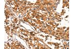 The image on the left is immunohistochemistry of paraffin-embedded Human thyroid cancer tissue using CSB-PA936982(DDAH2 Antibody) at dilution 1/15, on the right is treated with synthetic peptide. (Original magnification: 