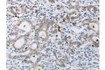 The image on the left is immunohistochemistry of paraffin-embedded Human gastic cancer tissue using CSB-PA937099(ABCB9 Antibody) at dilution 1/15, on the right is treated with synthetic peptide. (Original magnification: 