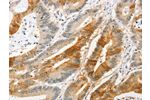 The image on the left is immunohistochemistry of paraffin-embedded Human colon cancer tissue using CSB-PA937183(ANAPC2 Antibody) at dilution 1/20, on the right is treated with fusion protein. (Original magnification: 