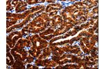 The image is immunohistochemistry of paraffin-embedded Human thyroid cancer tissue using CSB-PA937228(AK1 Antibody) at dilution 1/25. (Original magnification: 