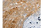 The image on the left is immunohistochemistry of paraffin-embedded Human cervical cancer tissue using CSB-PA937611(EDNRB Antibody) at dilution 1/30, on the right is treated with synthetic peptide. (Original magnification: 