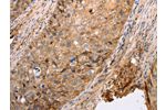 The image on the left is immunohistochemistry of paraffin-embedded Human cervical cancer tissue using CSB-PA938817(pan CDH Antibody) at dilution 1/20, on the right is treated with synthetic peptide. (Original magnification: 