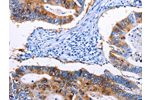 The image on the left is immunohistochemistry of paraffin-embedded Human colon cancer tissue using CSB-PA938899(EPCAM Antibody) at dilution 1/45, on the right is treated with synthetic peptide. (Original magnification: 