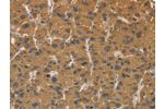 The image on the left is immunohistochemistry of paraffin-embedded Human liver cancer tissue using CSB-PA939101(CYP17A1 Antibody) at dilution 1/30, on the right is treated with fusion protein. (Original magnification: 