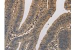 The image on the left is immunohistochemistry of paraffin-embedded Human colon cancer tissue using CSB-PA939360(ELOVL1 Antibody) at dilution 1/50, on the right is treated with fusion protein. (Original magnification: 