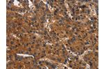 The image on the left is immunohistochemistry of paraffin-embedded Human liver cancer tissue using CSB-PA939516(CEACAM1 Antibody) at dilution 1/30, on the right is treated with synthetic peptide. (Original magnification: 