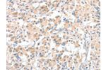 The image on the left is immunohistochemistry of paraffin-embedded Human thyroid cancer tissue using CSB-PA939596(CLIP1 Antibody) at dilution 1/30, on the right is treated with fusion protein. (Original magnification: 
