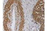 The image on the left is immunohistochemistry of paraffin-embedded Human cervical cancer tissue using CSB-PA939763(EMC8 Antibody) at dilution 1/30, on the right is treated with fusion protein. (Original magnification: 