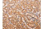 The image on the left is immunohistochemistry of paraffin-embedded Human thyroid cancer tissue using CSB-PA940023(ADH1B Antibody) at dilution 1/60, on the right is treated with synthetic peptide. (Original magnification: 