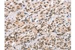 The image on the left is immunohistochemistry of paraffin-embedded Human esophagus cancer tissue using CSB-PA940399(CCNT1 Antibody) at dilution 1/20, on the right is treated with synthetic peptide. (Original magnification: 