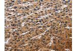 The image on the left is immunohistochemistry of paraffin-embedded Human liver cancer tissue using CSB-PA940544(EIF4EBP2 Antibody) at dilution 1/40, on the right is treated with fusion protein. (Original magnification: 