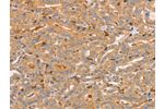 The image on the left is immunohistochemistry of paraffin-embedded Human thyroid cancer tissue using CSB-PA940582(CCL16  Antibody) at dilution 1/60, on the right is treated with synthetic peptide. (Original magnification: 