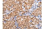 The image on the left is immunohistochemistry of paraffin-embedded Human breast cancer tissue using CSB-PA940873(BRMS1 Antibody) at dilution 1/20, on the right is treated with synthetic peptide. (Original magnification: 