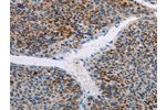 The image on the left is immunohistochemistry of paraffin-embedded Human liver cancer tissue using CSB-PA940902(AMOTL2 Antibody) at dilution 1/20, on the right is treated with fusion protein. (Original magnification: 