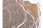 The image on the left is immunohistochemistry of paraffin-embedded Human liver cancer tissue using CSB-PA940948(CD151 Antibody) at dilution 1/25, on the right is treated with fusion protein. (Original magnification: 