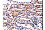 The image on the left is immunohistochemistry of paraffin-embedded Human thyroid cancer tissue using CSB-PA940971(CFTR Antibody) at dilution 1/8, on the right is treated with synthetic peptide. (Original magnification: 