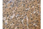 The image on the left is immunohistochemistry of paraffin-embedded Human liver cancer tissue using CSB-PA940977(DUSP26 Antibody) at dilution 1/60, on the right is treated with fusion protein. (Original magnification: 