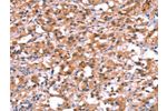 The image on the left is immunohistochemistry of paraffin-embedded Human thyroid cancer tissue using CSB-PA941444(BCAR1 Antibody) at dilution 1/15, on the right is treated with synthetic peptide. (Original magnification: 