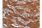 The image on the left is immunohistochemistry of paraffin-embedded Human gastic cancer tissue using CSB-PA942031(FEM1B Antibody) at dilution 1/20, on the right is treated with synthetic peptide. (Original magnification: 